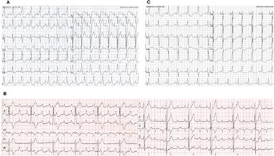 Left Bundle Pacing for Left Bundle Branch Block and Intermittent Third-Degree Atrioventricular Block in a MYH7 Mutation-Related Hypertrophic Cardiomyopathy With Restrictive Phenotype in a Child